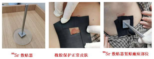 瘢痕疙瘩又丑、又癢、又痛怎么辦?它的&ldquo;克星&rdquo;來了