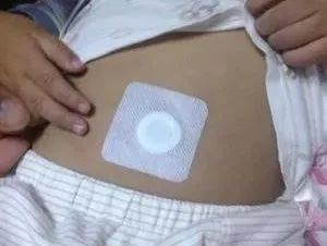 小兒積滯，秘密武器來幫你——敷貼器